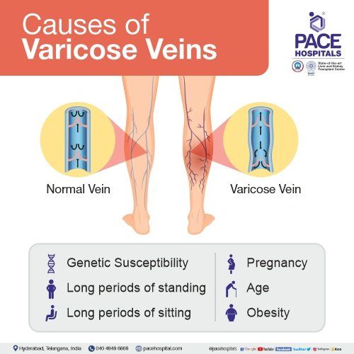 Varicose Veins Symptoms Causes Complications And Treatment